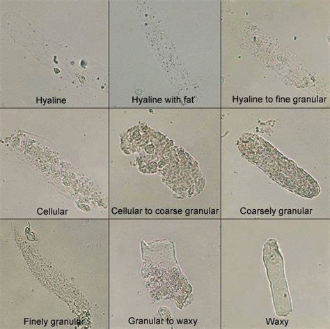 Factors known to be promoters of cast formation | Medical Laboratories