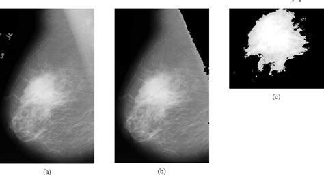 Figure 2 from Classification of benign and malignant masses in breast ...