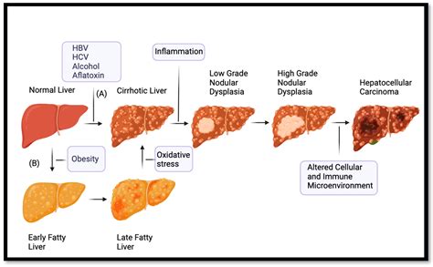 IJMS | Free Full-Text | Hepatocellular Carcinoma: Past and Present Challenges and Progress in ...