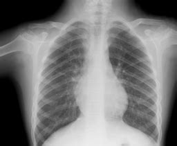 hepatopulmonary syndrome