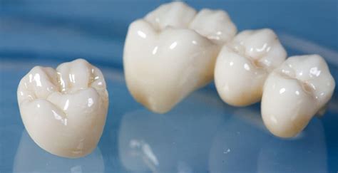 The Start-to-Finish Dental Crown Procedure Guide