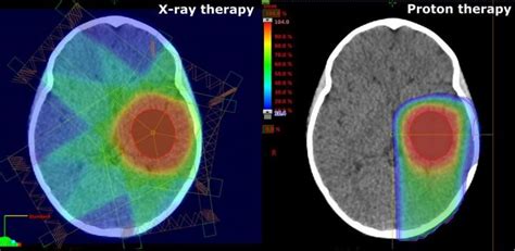 How safe is proton therapy for [IMAGE] | EurekAlert! Science News Releases