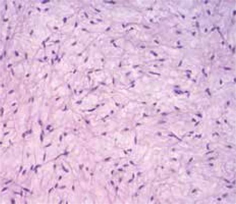 Odontogenic Myxoma Histology