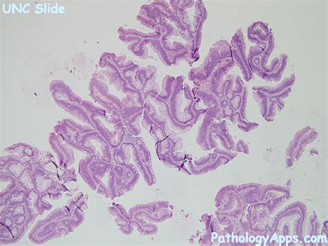 villous adenoma pathology