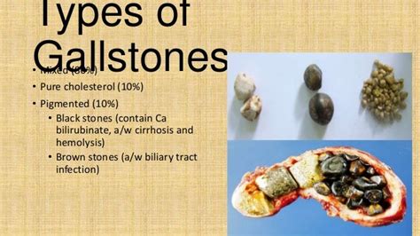 Gall stone disease