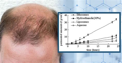 How Long Does Finasteride Stay in Scalp Tissue? - Perfect Hair Health