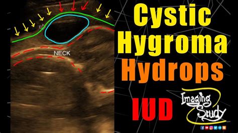 Cystic Hygroma || Hydrops Fetalis || Ultrasound || Anomaly || Case 214 ...