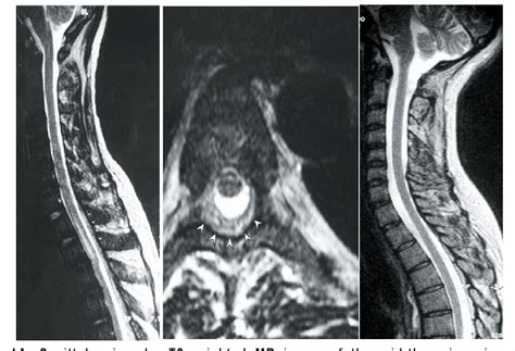 Figure 1 from SPINAL CORD COMPRESSION DUE TO EPIDURAL EXTRAMEDULLARY HAEMATOPOIESIS IN ACUTE ...