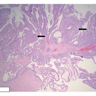 Tubulovillous adenoma with high-grade dysplasia. Ileal polyp showing... | Download Scientific ...