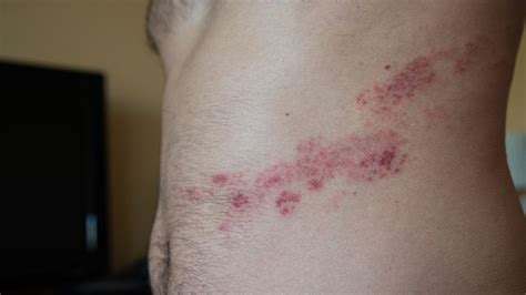 Stages Of Shingles Rash Pictures | edu.svet.gob.gt