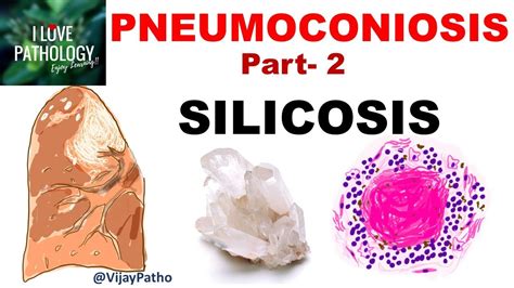 Silicosis Histology