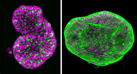 Prostate Cancer Organoids Open Path to Precision Oncology