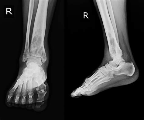 Premium Photo | X-ray rt.ankle finding intramedullary osterolytic lesion of right distal tibia