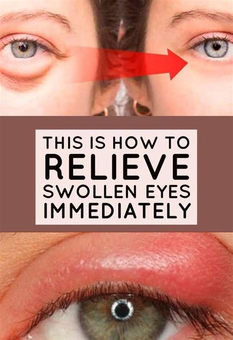 How To Get Rid Of Eye Pimple | Swollen eyes, Swollen eye remedies, Swollen eyelids remedy