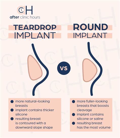 Pinterest | Implants breast, Breast implants sizes, Breast augmentation