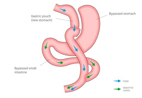 Roux en Y Gastric Bypass - Discover Weight Loss