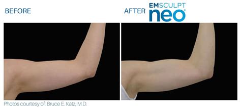 Emsculpt NEO Before and After | Real Patient Results