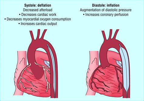 Pump: Intra Aortic Balloon Pump