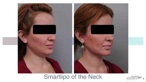 Double Chin Liposuction With Smartlipo™ | Dr. Sterry Explains - YouTube