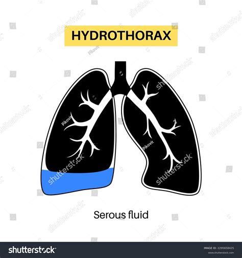 Hydrothorax Lungs Disease Noninflammatory Serous Fluid Stock Vector ...