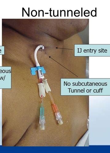 Groshong Catheter