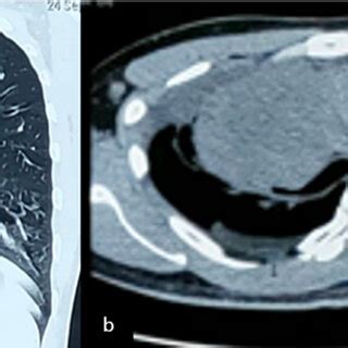 -The thorax CT scan obtained on the first admission showed a solid mass ...