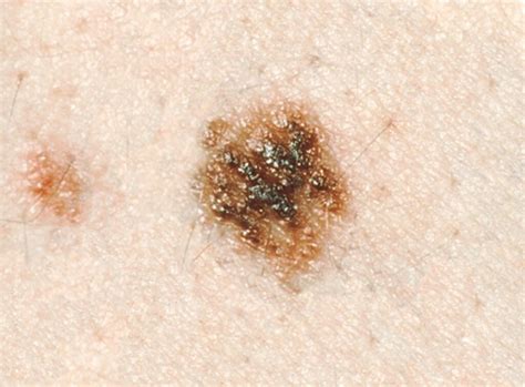 What Does Precancerous or Atypical Mole Mean? » Scary Symptoms