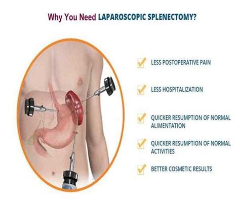 Are There Complications Faced Post-Laparoscopic Splenectomy Surgery? - MindStick