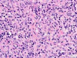 Kikuchi-Fujimoto Disease Pathology, Histology, and Skin lesions