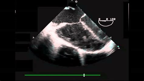 Primum ASD Transesophageal Echocardiogram Four Chamber View - YouTube