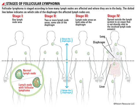 Follicular Lymphoma Staging