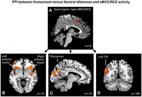 Areas showing increased coupling with right anterior midcingulate cortex (aMCC)/rostral ...