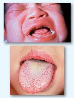 Thrush in Babies (Hazards Thrush in Babies) | saliva