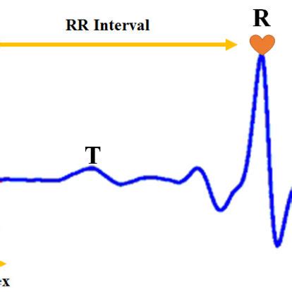 R-wave detection in the ECG signal. | Download Scientific Diagram