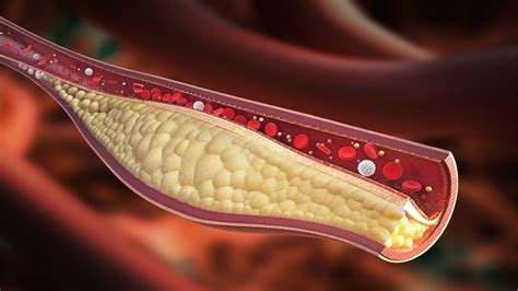 Calcium Buildup in Young Arteries May Signal Heart Attack Risk | Everyday Health