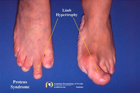 Proteus Syndrome: God of Shapeshifting... - Academic Dermatology of Nevada