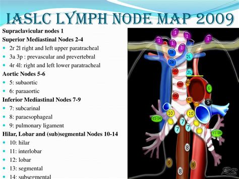 Hilar Lymph Nodes Lung Cancer