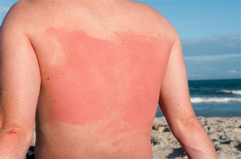 9 Most Effective Home Remedies To Heal A Sunburn Fast (With images) | Sunburn remedies, Natural ...