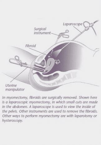 Myomectomy - Hackensack, NJ: Women’s Pelvic Surgery, LLC