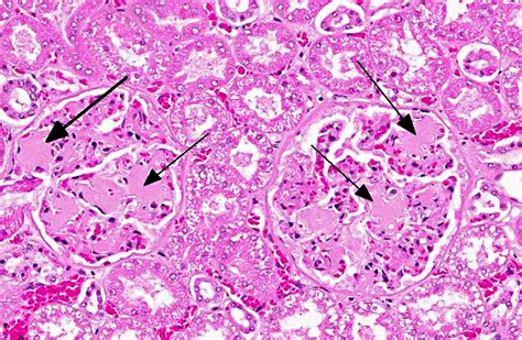 Amyloidosis Histology