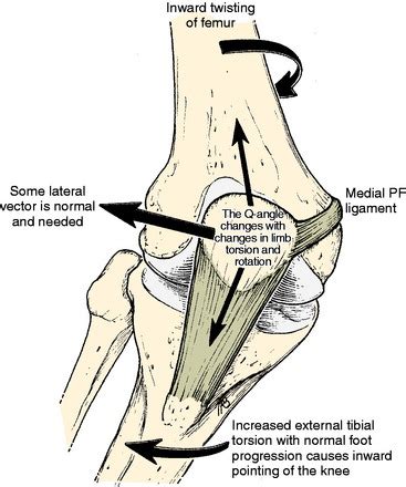 Patellofemoral Disorders: Correction of Rotational Malalignment of the Lower Extremity ...