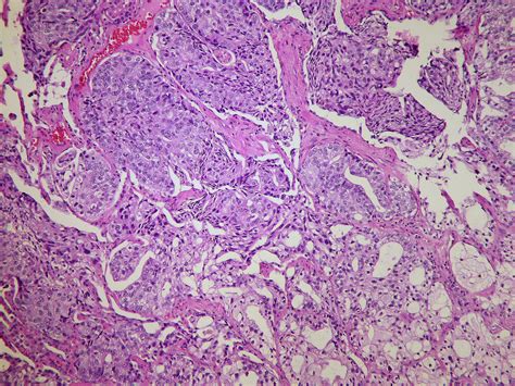 Metastatic prostatic adenocarcinoma Case 207 | Atlas of Pulmonary Pathology | Flickr