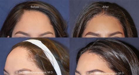 Hairline Lowering | Beverly Hills Plastic Surgeon - Dr. Jason Champagne