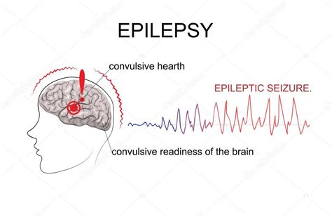 Epilepsy Brain Diagram