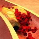 Peripheral Vascular Disease Causes, Symptoms and Treatment