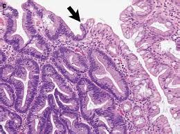 Understanding Sessile Serrated Adenoma: Causes, Symptoms, and Treatment - CuriousQuill