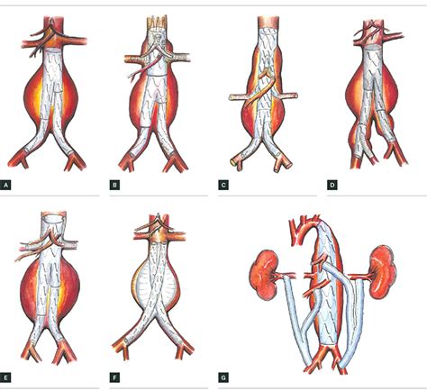 Endovascular Aortic Aneurysm Repair (EVAR): Risks Benefits And Complications | Steve Gallik