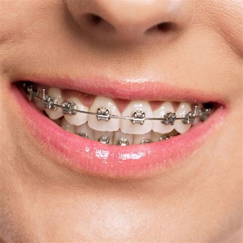 Types of Braces - Drake Orthodontics