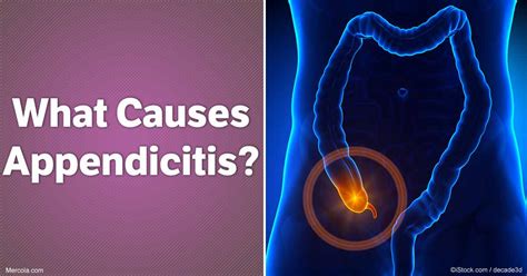 What Causes Appendicitis?