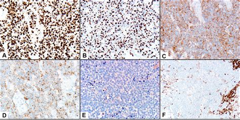 Immunohistochemical profile of Merkel cell carcinoma Merkel cell... | Download Scientific Diagram